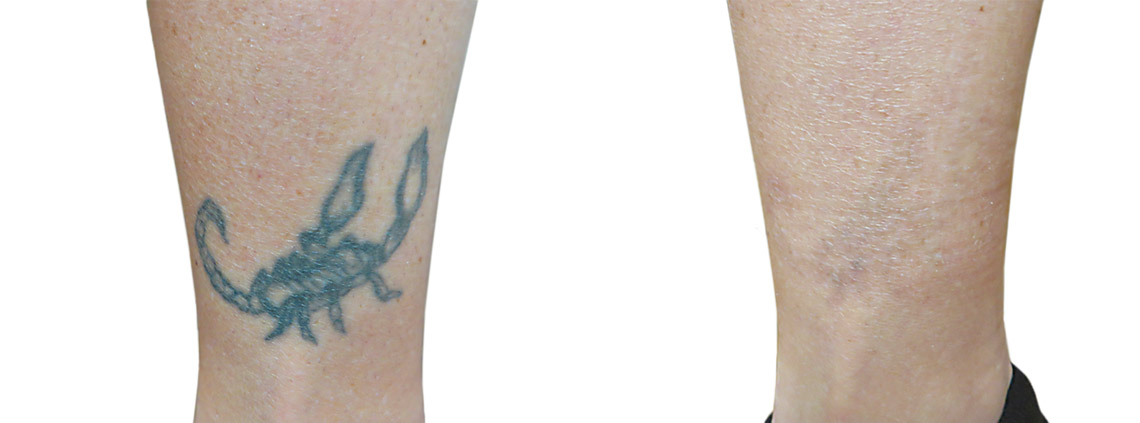 Laser removal of tattoos and permanent make-up Q-Switch (Spectra)