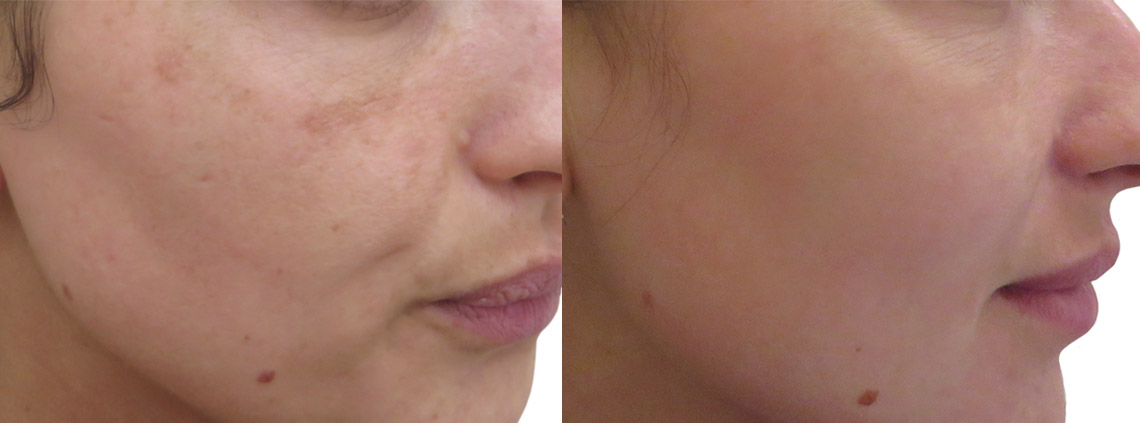 Laser removal of discolourations (Clarity II)