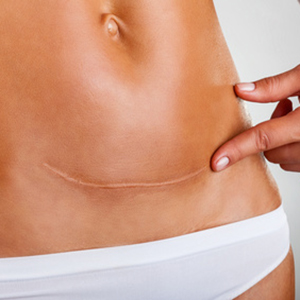 Laser removal of scars and stretch marks