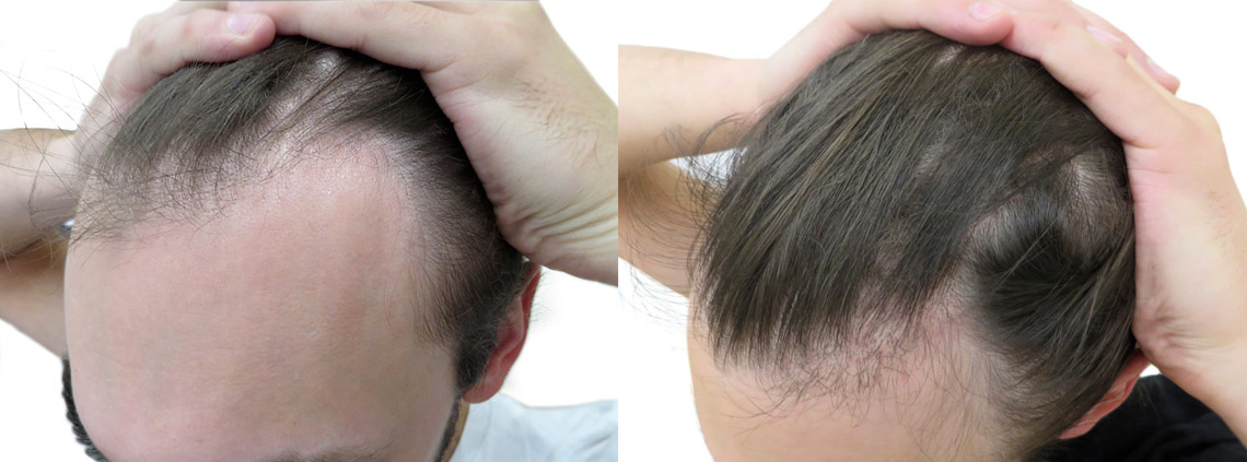 Przeszczep włosów metodą SAFER