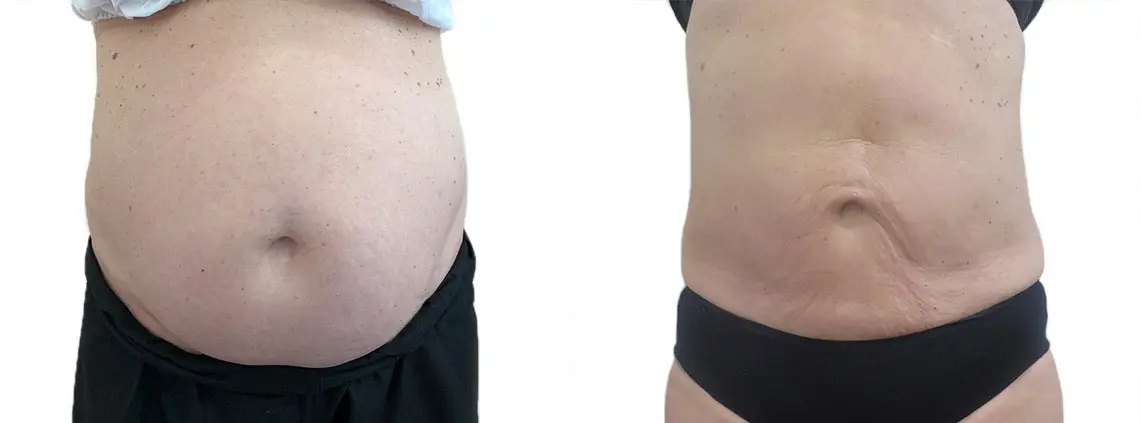 Vaser Lipo liposuction