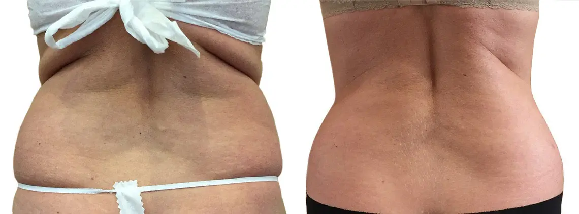 Vaser Lipo liposuction