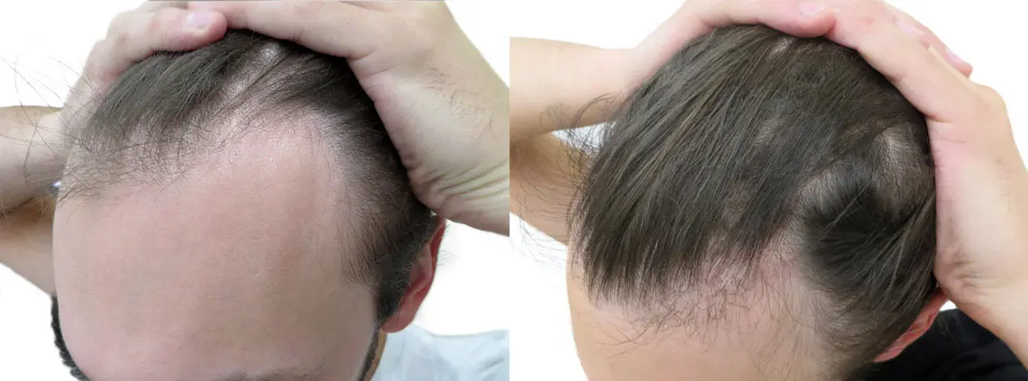 Hair transplant SAFER