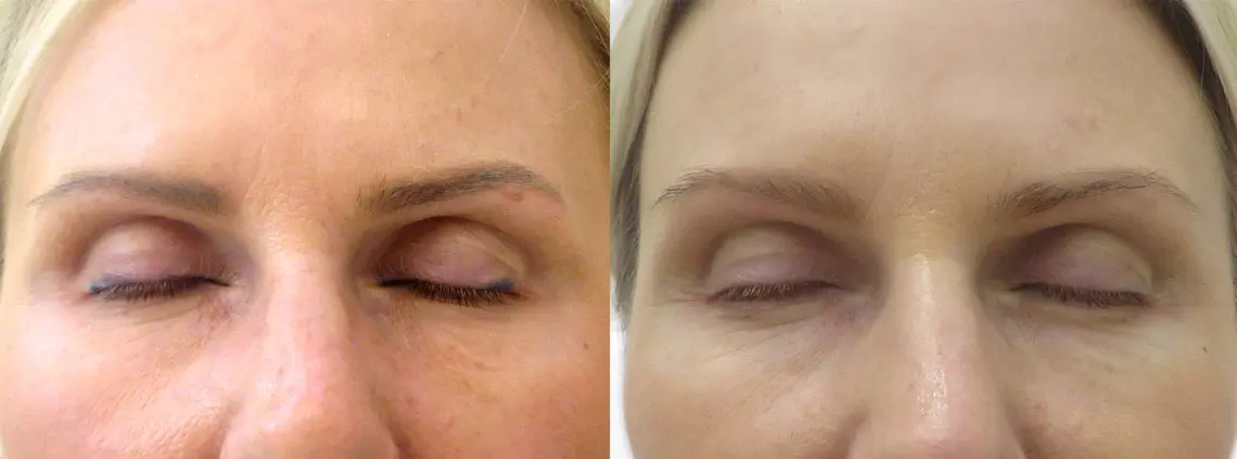 Laserowe usuwanie makijażu permanentnego 