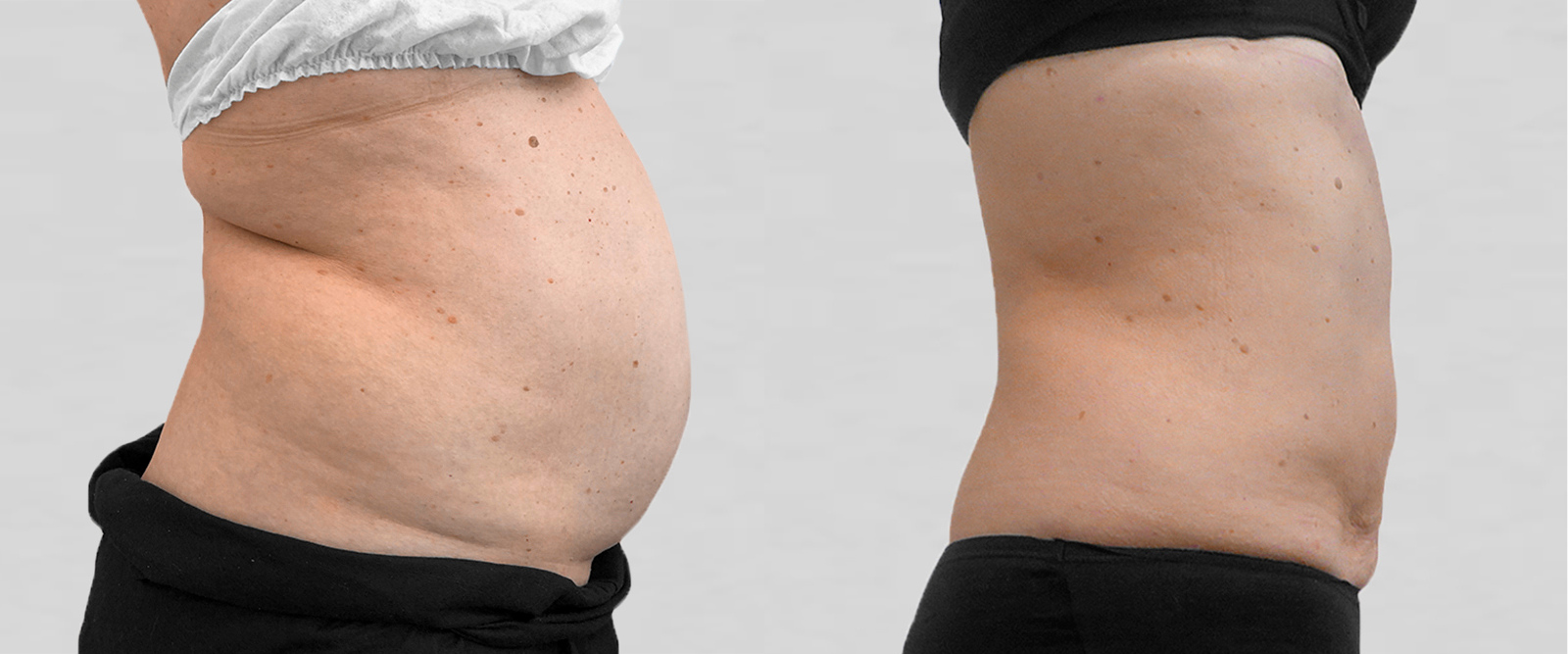 VASER LIPO HD ultrasound liposuction