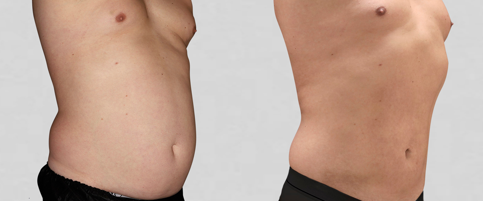 VASER LIPO HD ultrasound liposuction