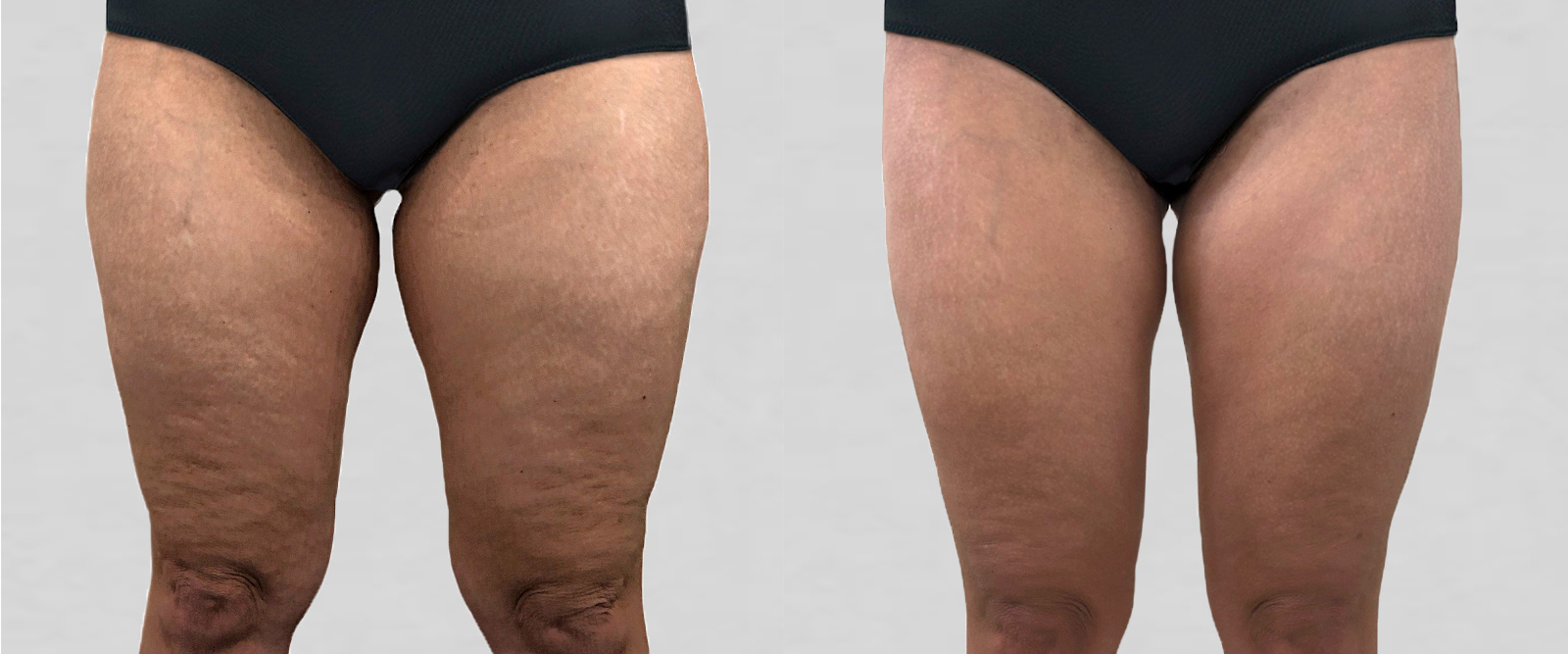 VASER LIPO HD ultrasound liposuction