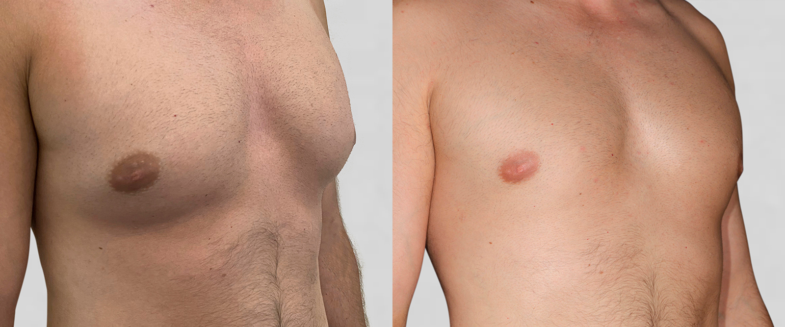 VASER LIPO HD ultrasound liposuction