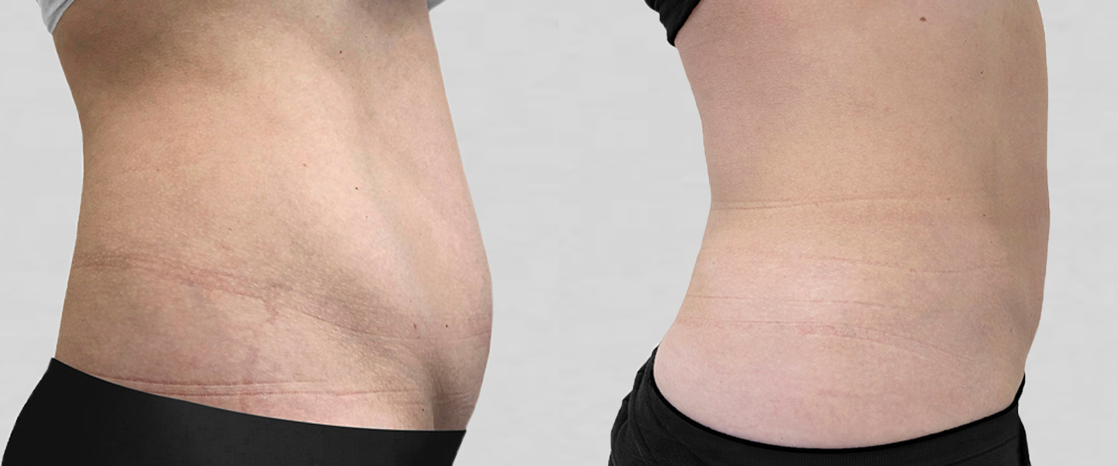 VASER LIPO HD ultrasound liposuction