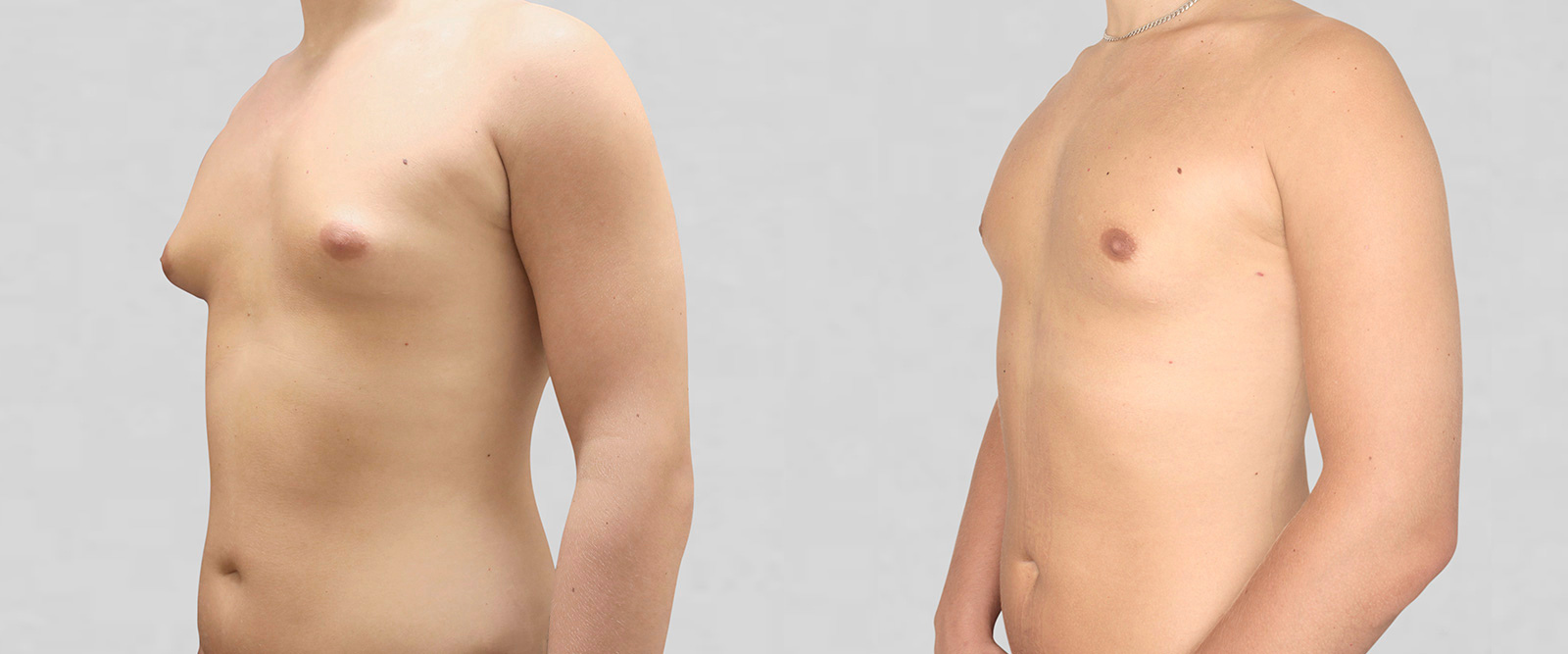 VASER LIPO HD ultrasound liposuction