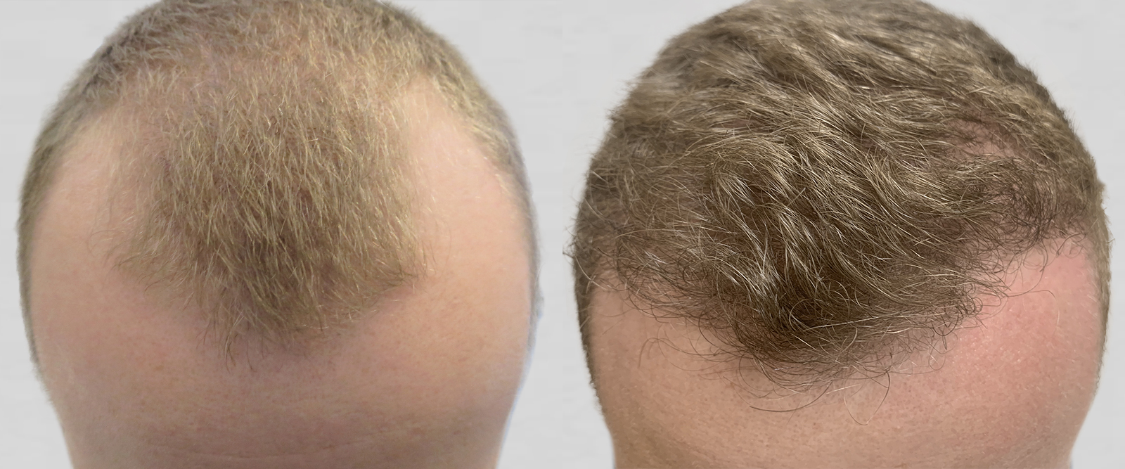 .. (Suction Assisted Follicular Extraction and Re-implantation) - a  minimally invasive hair transplant technique
