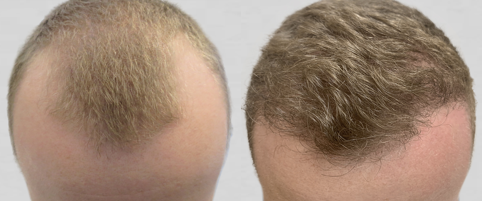 S.A.F.E.R. Hair Transplantation