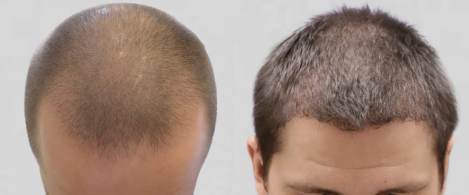 S.A.F.E.R. Hair Transplantation