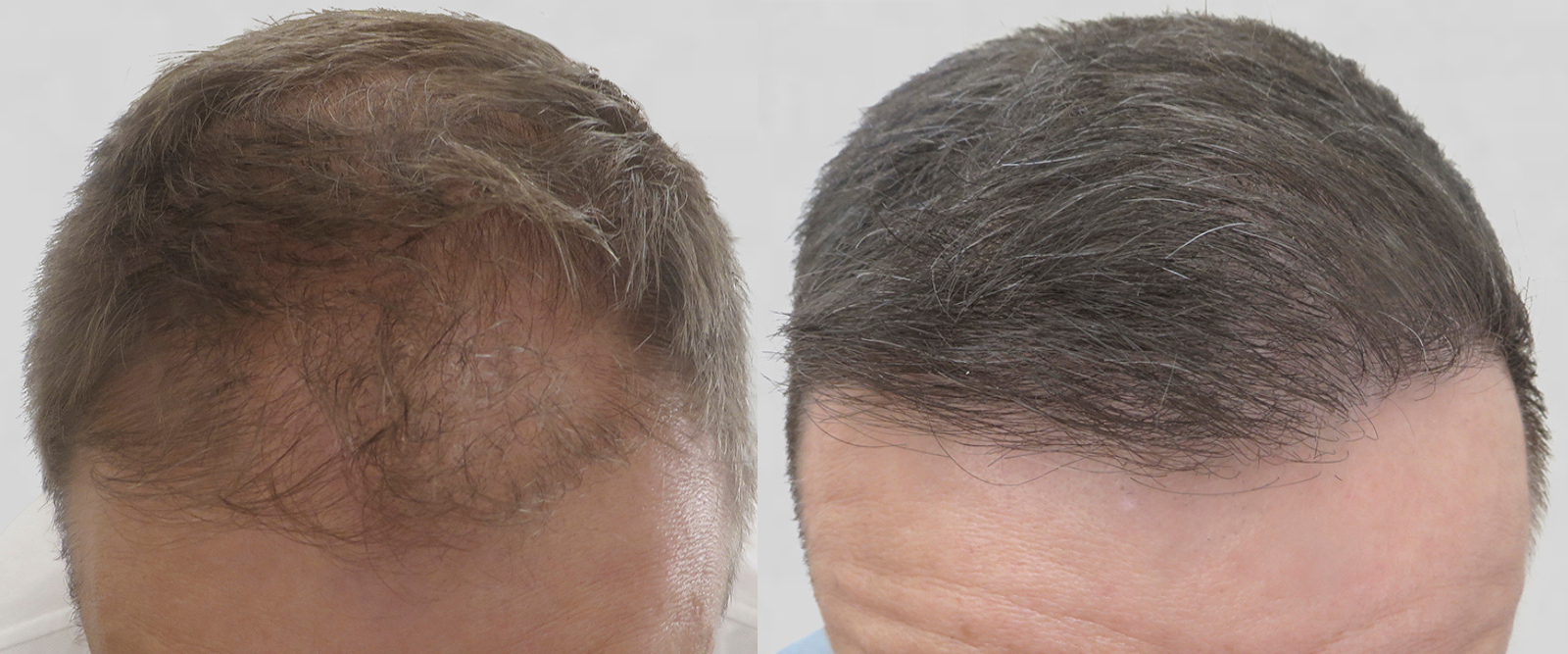 S.A.F.E.R. Hair Transplantation