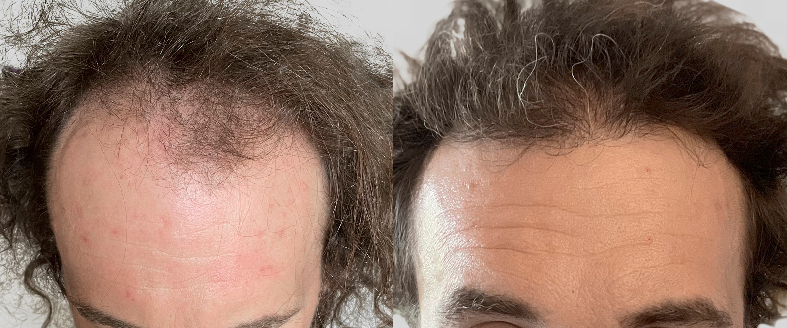 S.A.F.E.R. Hair Transplantation