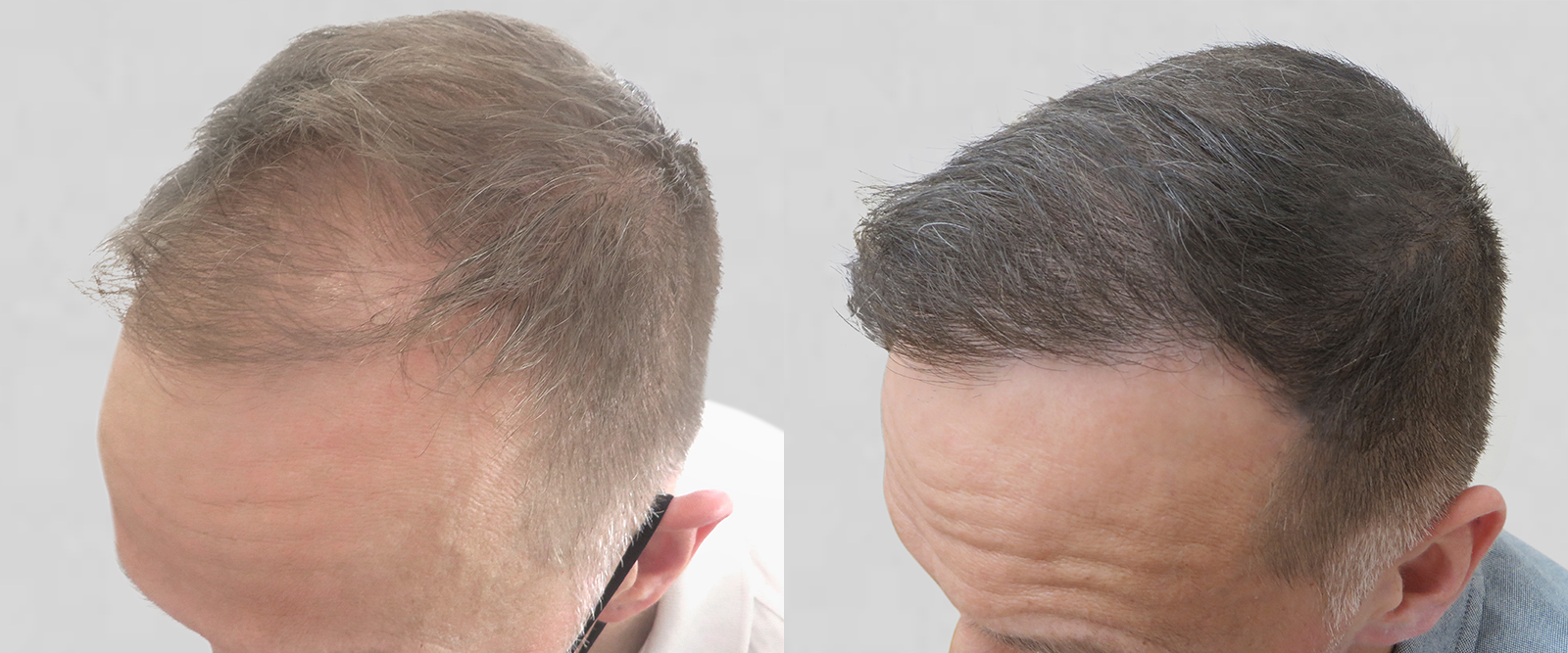 S.A.F.E.R. Hair Transplantation