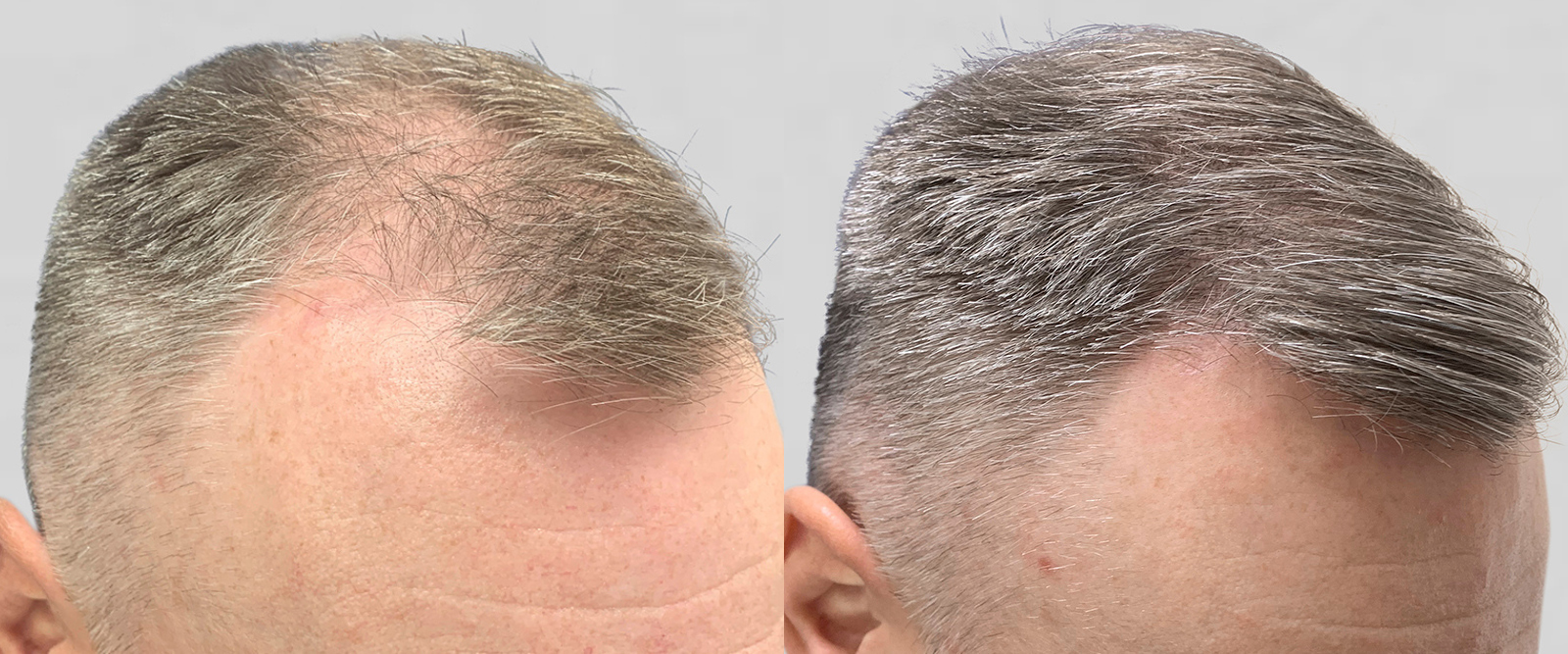 S.A.F.E.R. Hair Transplantation