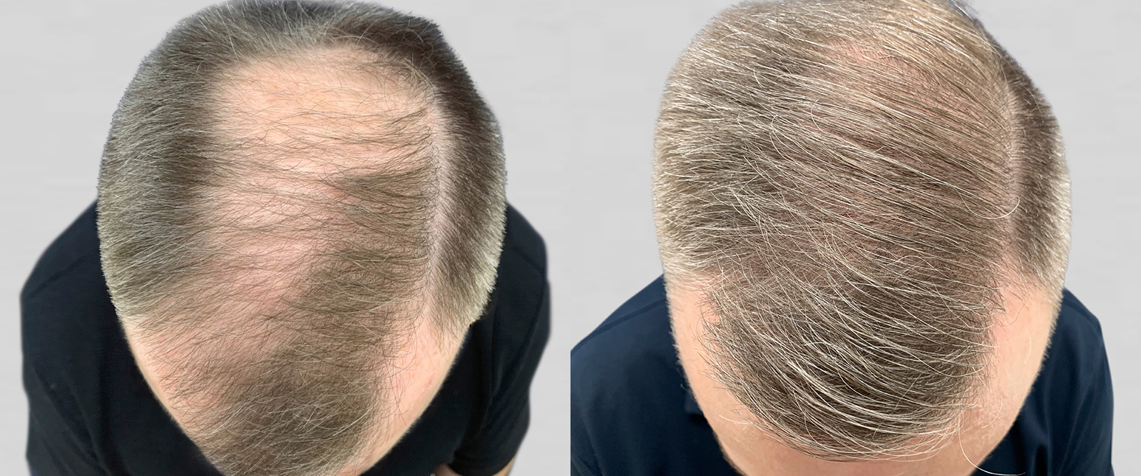 S.A.F.E.R. Hair Transplantation