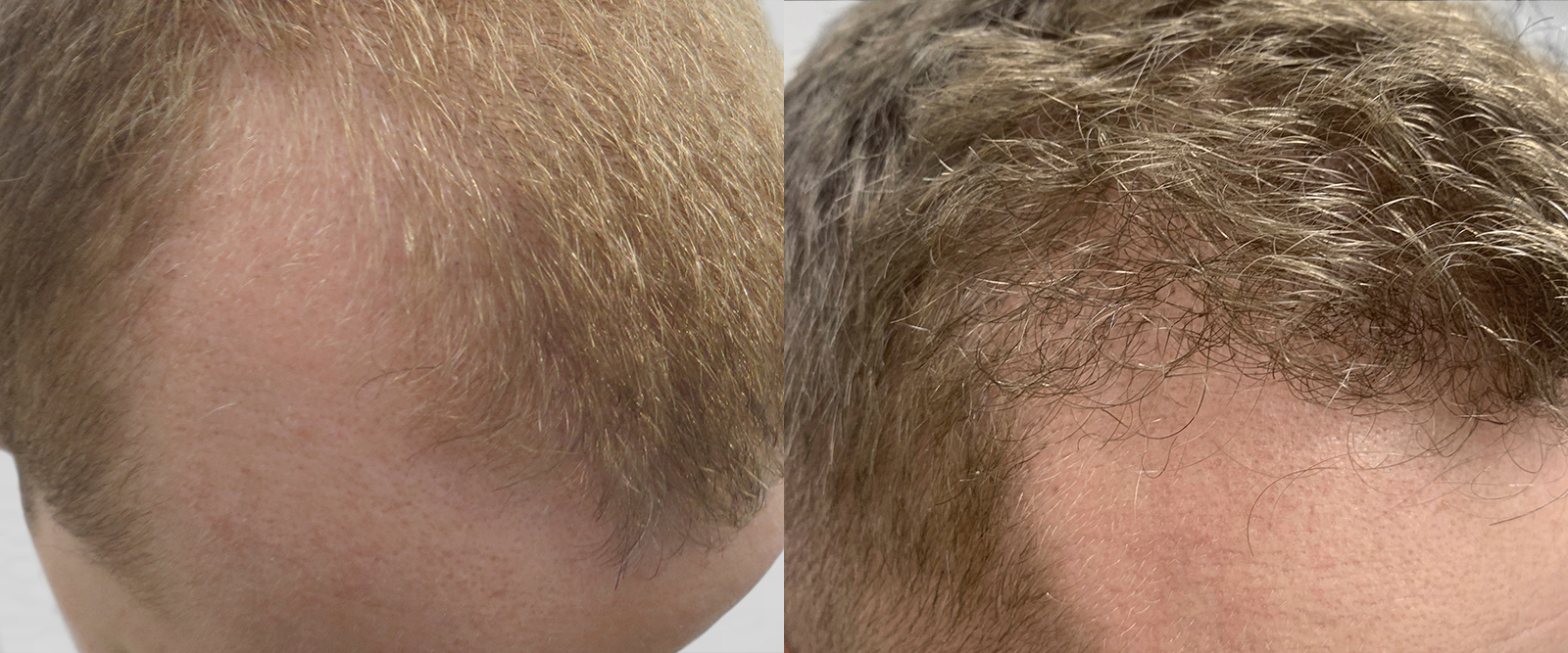 S.A.F.E.R. Hair Transplantation