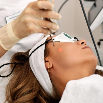 Laser skin regeneration around the eyes (Fotona Dynamis SP)