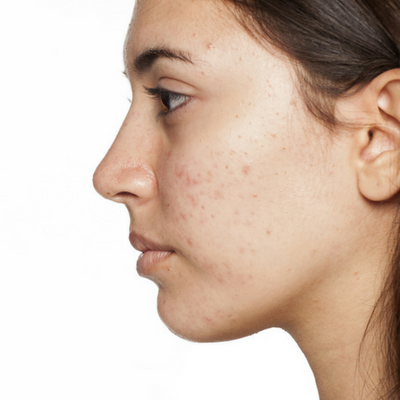 SEBACIA - a breakthrough treatment for acne!