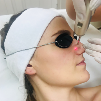 LASER TREATMENT OF DILATED CAPILLARIES (FOTONA DYNAMIS SP)